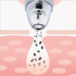 ⁦Facial Blackhead Remover Electric Pore Cleaner Face Deep Nose Cleaner T Zone Pore Acne Pimple Removal Vacuum Suction⁩ - الصورة ⁦6⁩